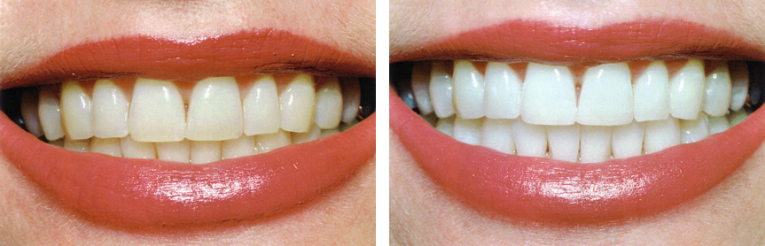teeth whitening pic